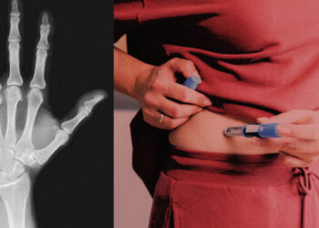 GLP-1 drugs like Ozempic can raise bone and tendon injury risk, study suggests