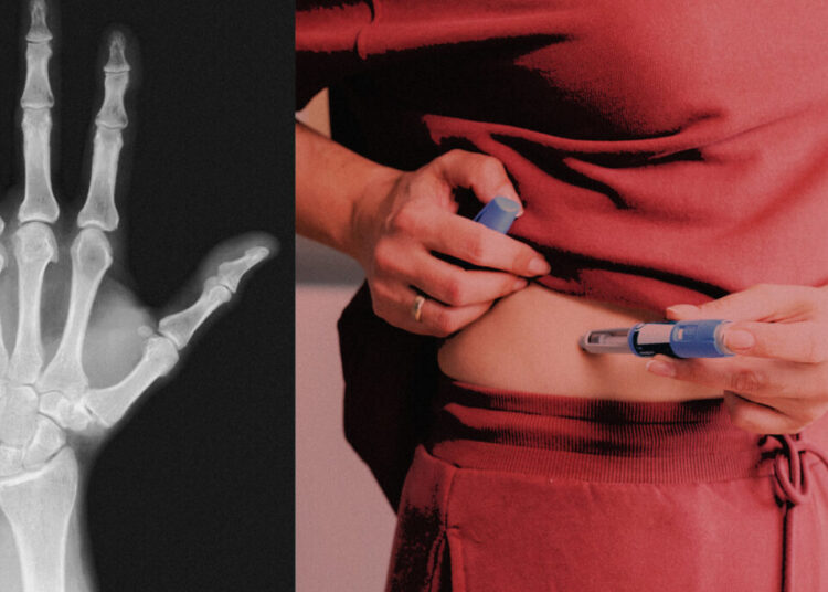 GLP-1 drugs like Ozempic can raise bone and tendon injury risk, study suggests