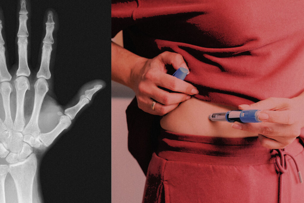 GLP-1 drugs like Ozempic can raise bone and tendon injury risk, study suggests