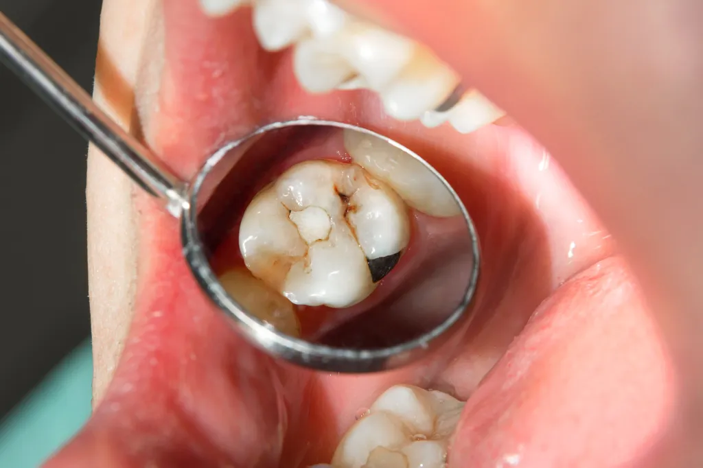 Close-up of a rotten tooth at the treatment stage in a dental clinic.