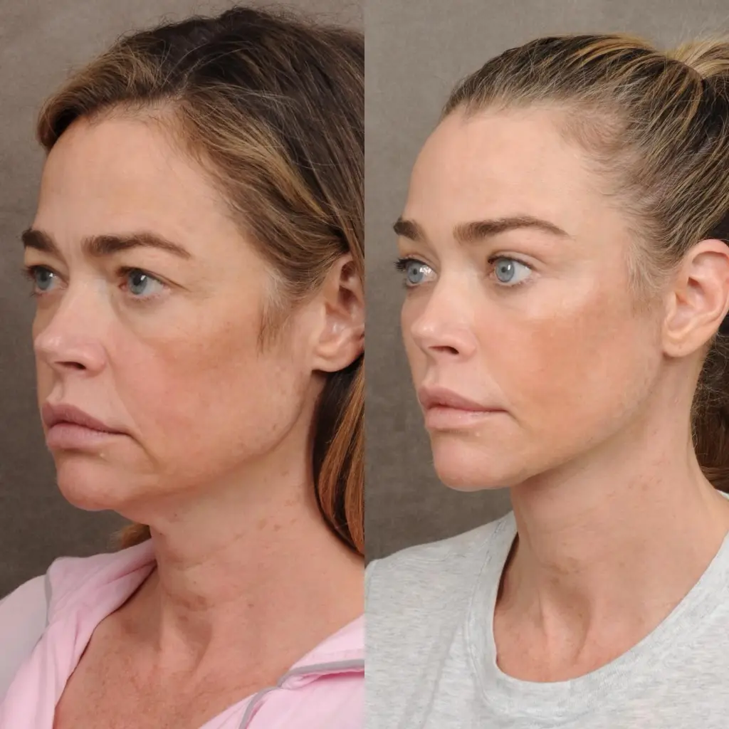 Collage of Denise Richards's before and after facelift photos.
