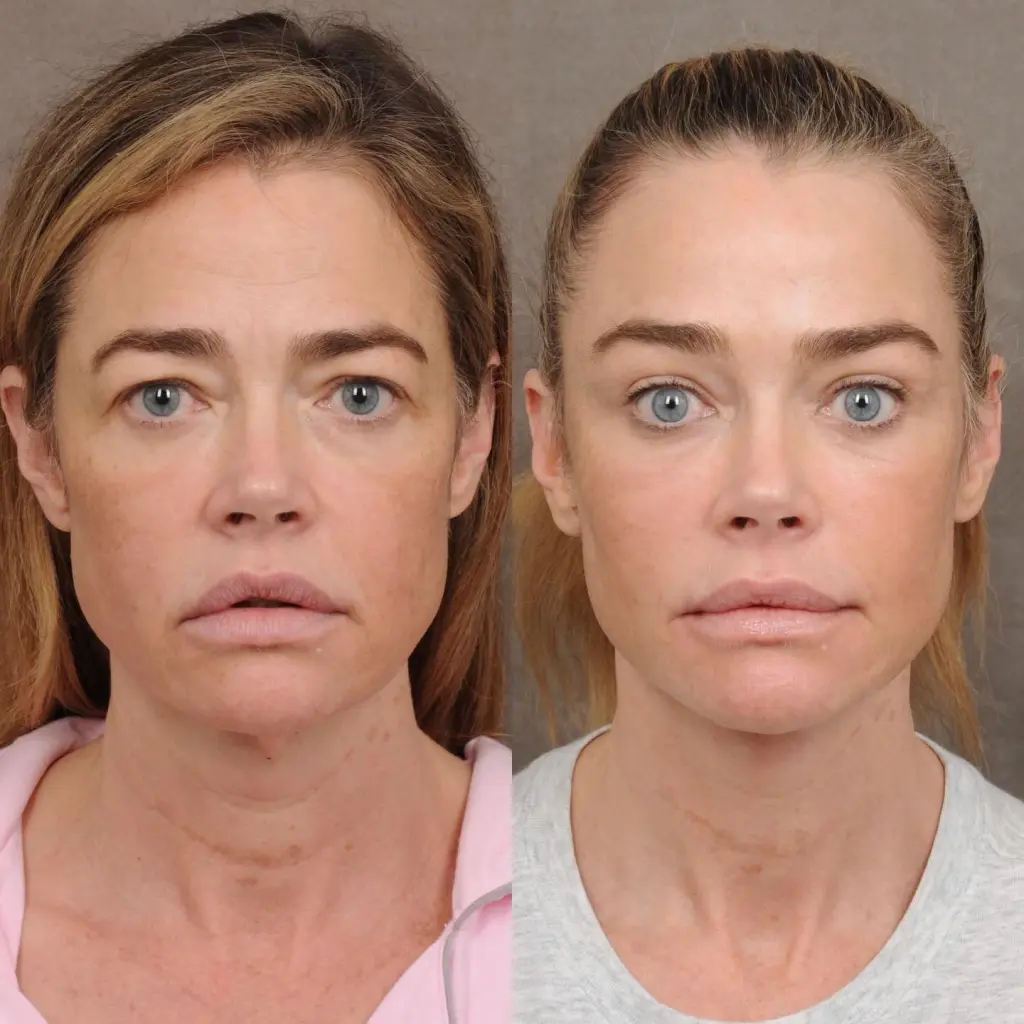 Collage of Denise Richards's before and after facelift transformation.