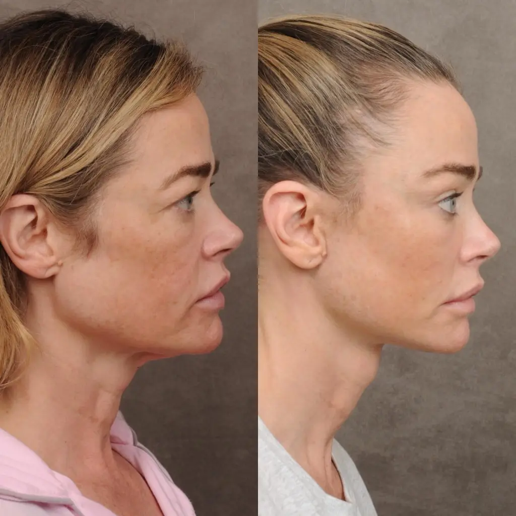 Before and after comparison of Denise Richards' facelift transformation.