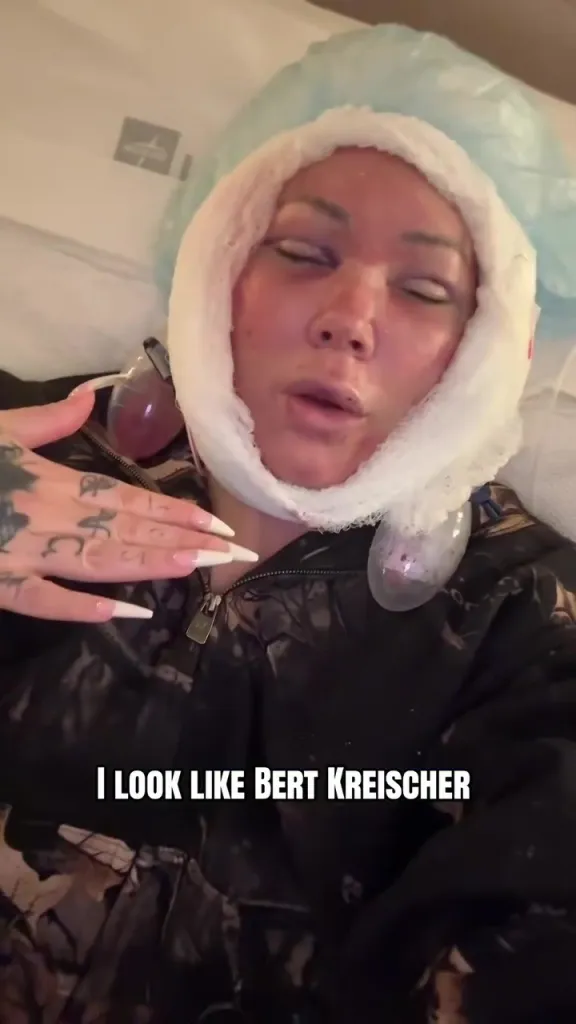 A woman with facial bandages after a facelift.