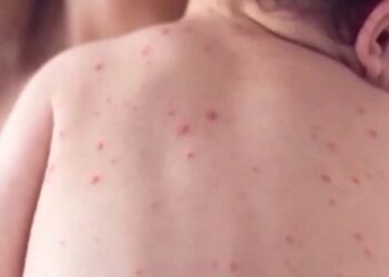 Health chief’s concerning three-word message as world’s most infectious disease rips across CA