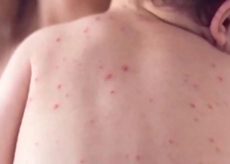 Health chief’s concerning three-word message as world’s most infectious disease rips across CA