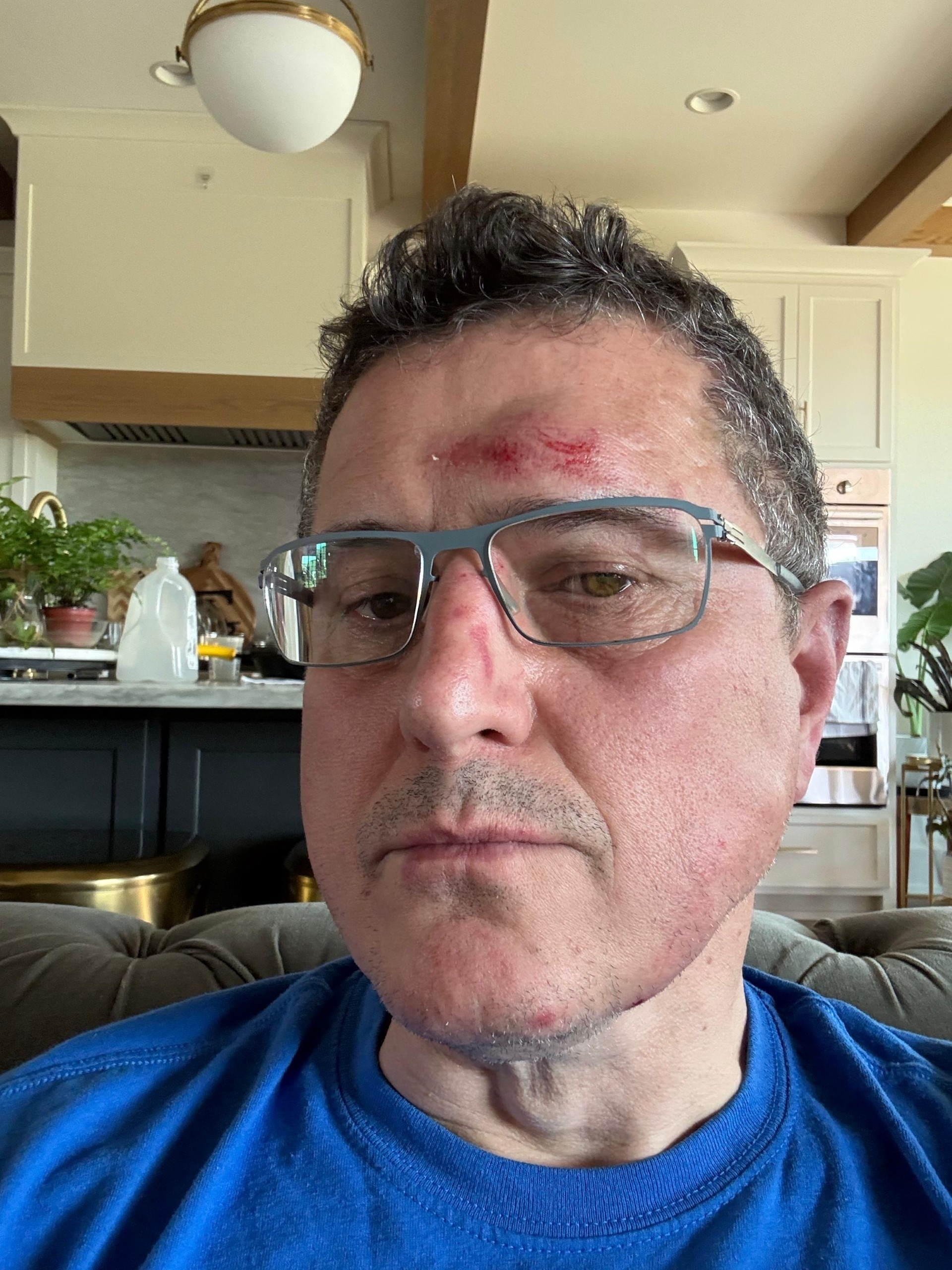 Ronnie Taylor showing injuries to his face, forehead, and nose.