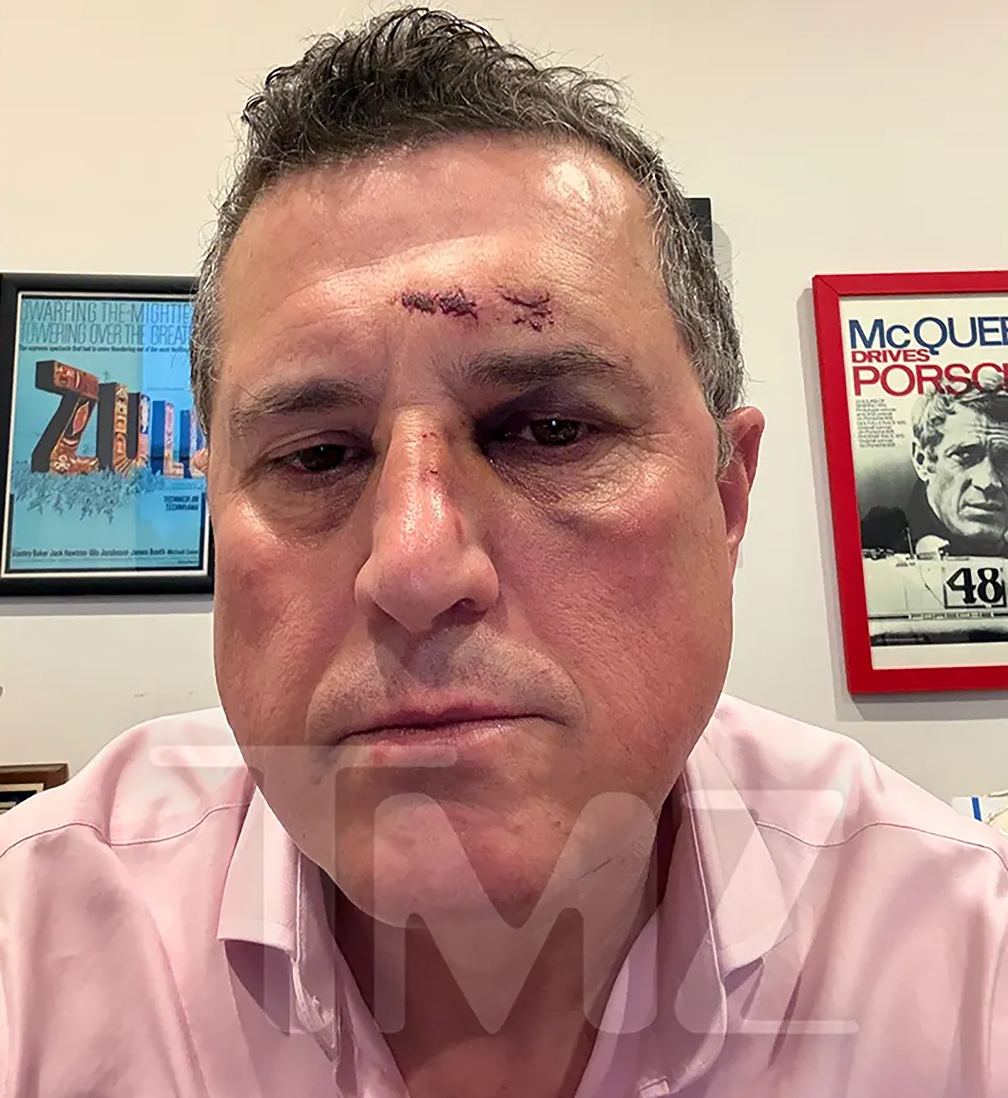 Ronnie Taylor with injuries to his forehead and nose.