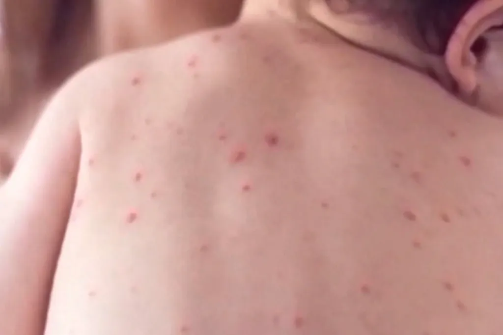 Close-up of a person's upper back and shoulder covered in a measles rash.