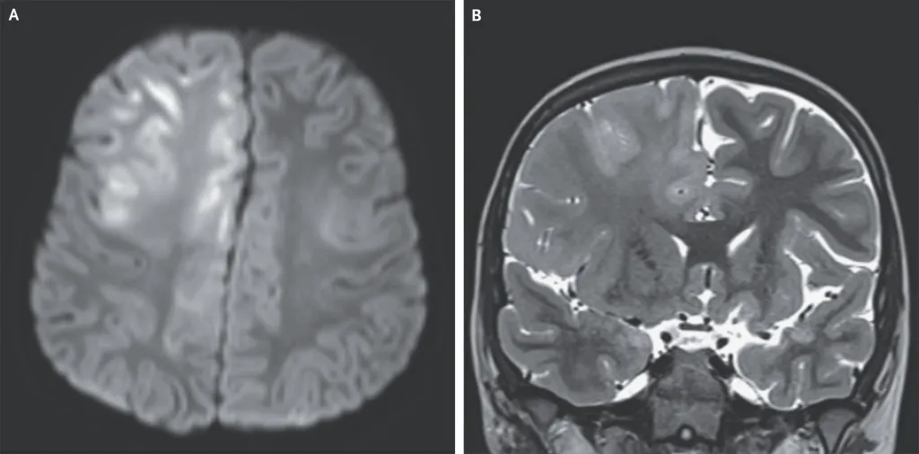 Collage of an axial diffusion-weighted MR image of the brain showing cortical signal abnormalities and a coronal T2-weighted MR image of the brain showing cerebral atrophy and signal abnormalities.