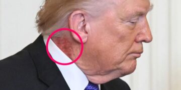 Strange Mark Appears on Trump’s Neck