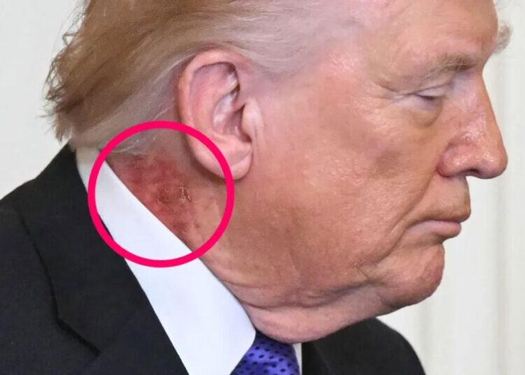 Strange Mark Appears on Trump’s Neck
