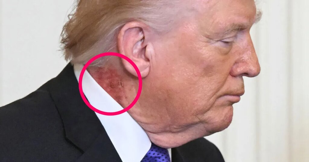 Strange Mark Appears on Trump’s Neck