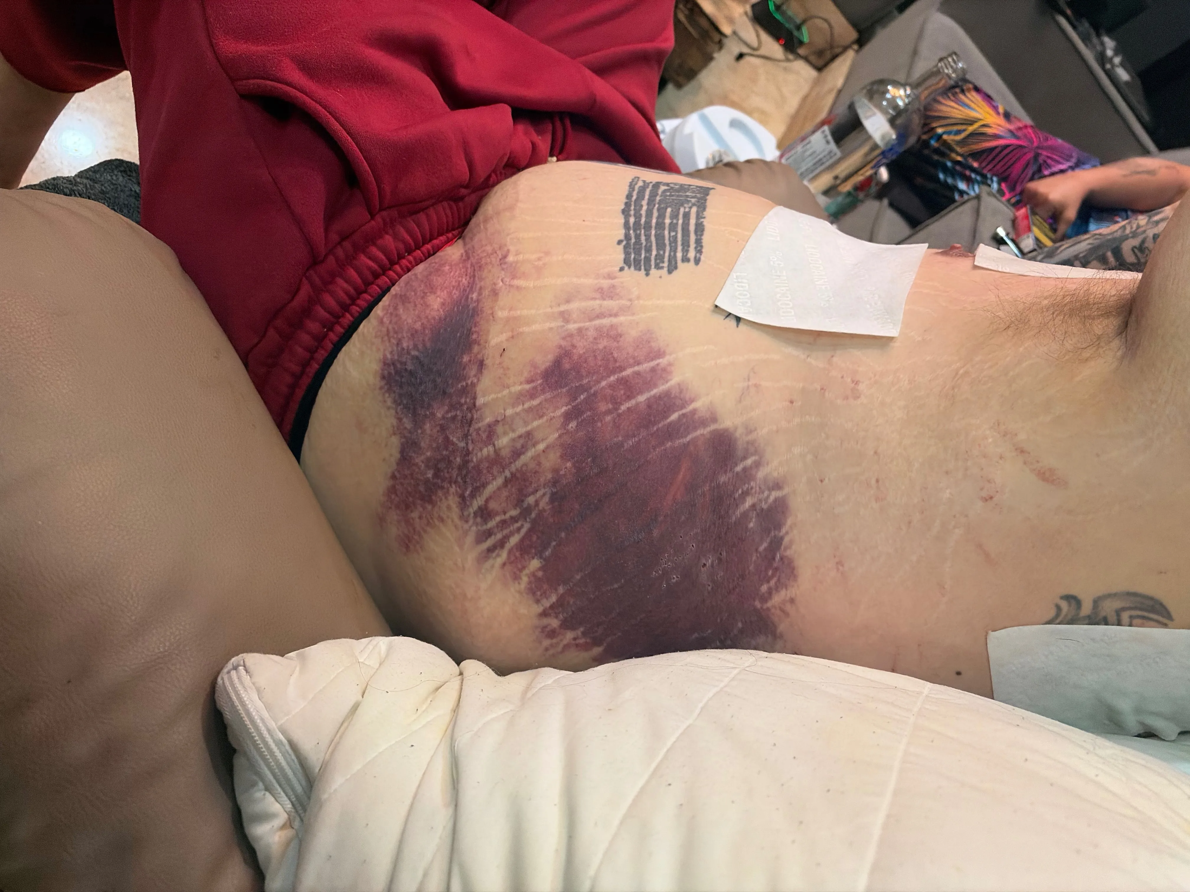 Corey's severely bruised torso, with two white patches placed on the right side.