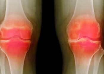 Federal Agency Unveils Three Potential Osteoarthritis Treatments