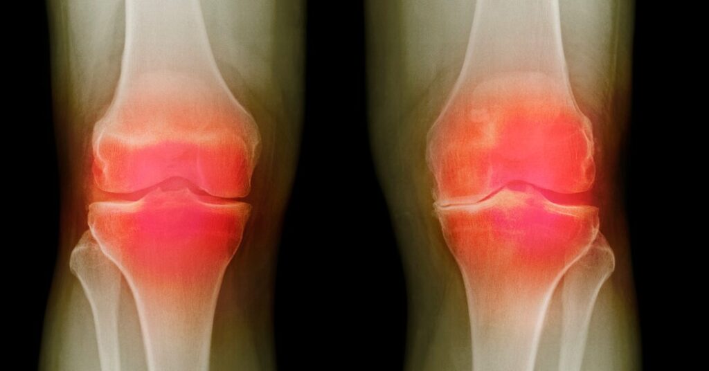 Federal Agency Unveils Three Potential Osteoarthritis Treatments