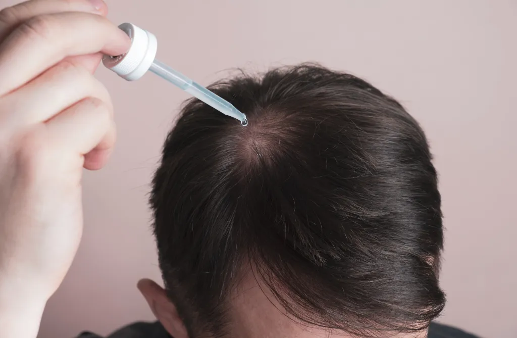 A man applies hair growth serum with a dropper to his scalp to treat thinning hair.