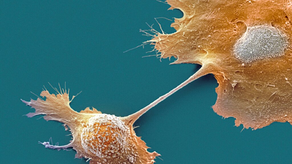 Two New Drugs Offer Hope for Pancreatic Cancer