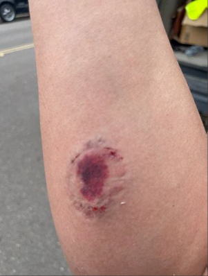 Bite mark on a forearm.