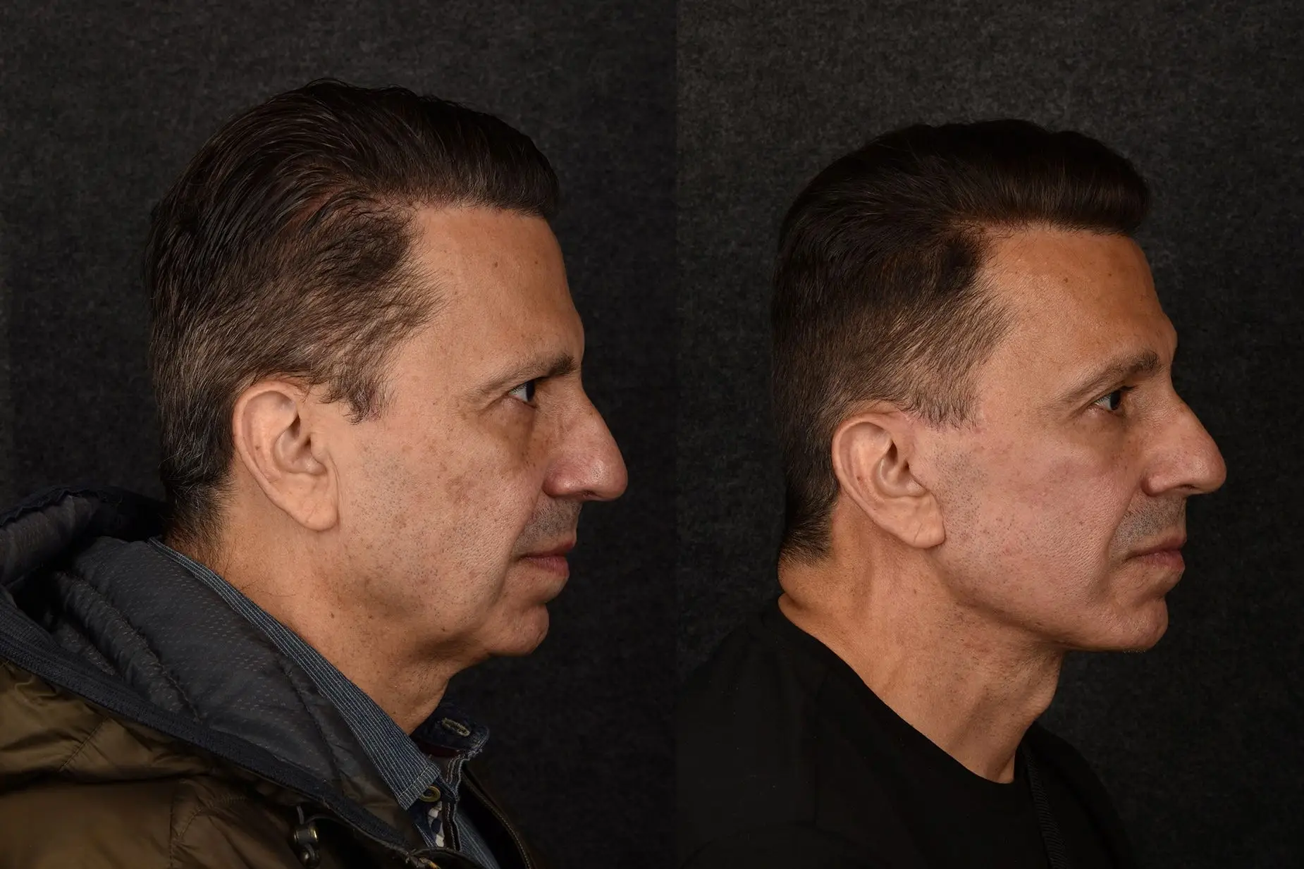 A patient who had a facelift and neck lift done by Sean Alemi.