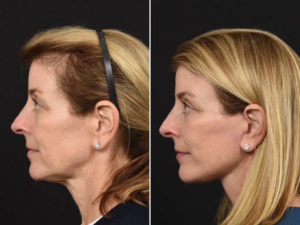 Babak Azzizadeh's client's before-and-after photos,