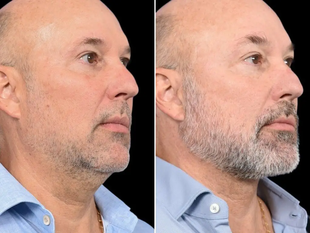 Babak Azizzadeh's client's before-and-after pictures.