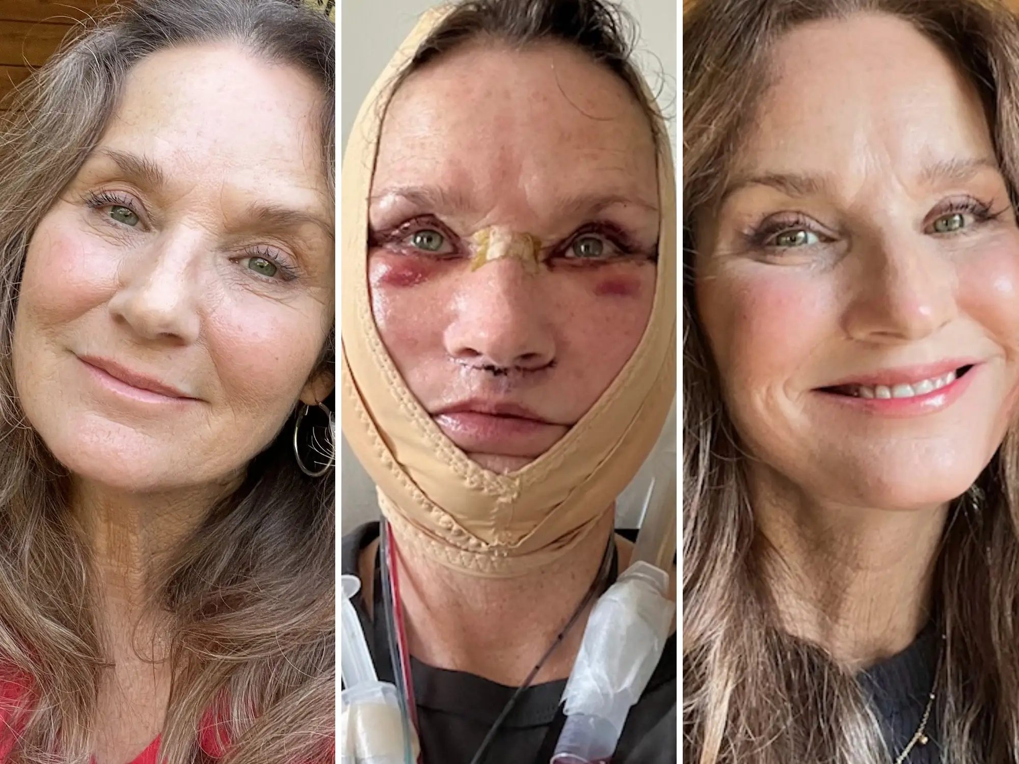 A woman before a facelift, immediately after surgery, and how she looks now.