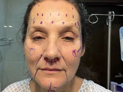A woman with markings on her face before a facelist.