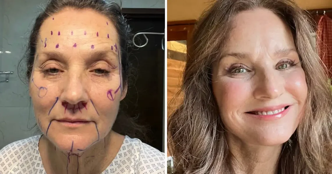 Against people’s advice, I traveled to Mexico for a facelift. They assumed it was risky, but it turned out to be great.