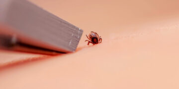 So, you got bit by a tick. Here’s exactly what to do next.