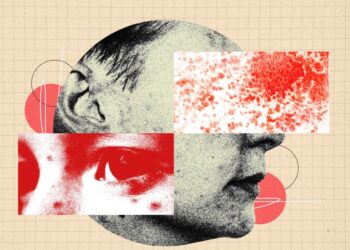 You Need to Be More Freaked Out by Shingles