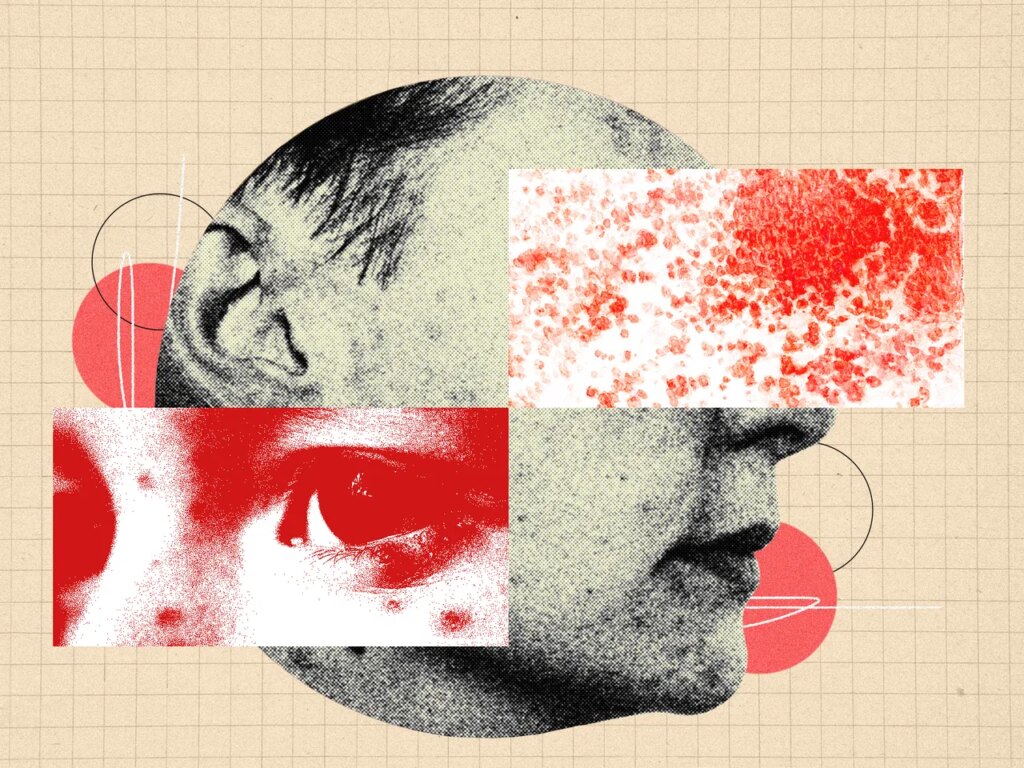 You Need to Be More Freaked Out by Shingles