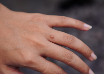 What you need to know about warts — and how to treat them at home