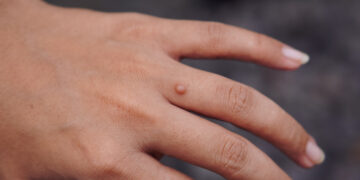 What you need to know about warts — and how to treat them at home