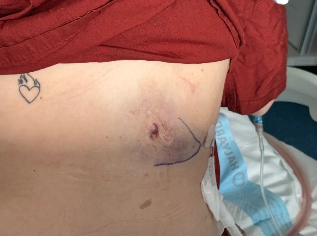 Bullet wound on a person's torso next to a heart tattoo.