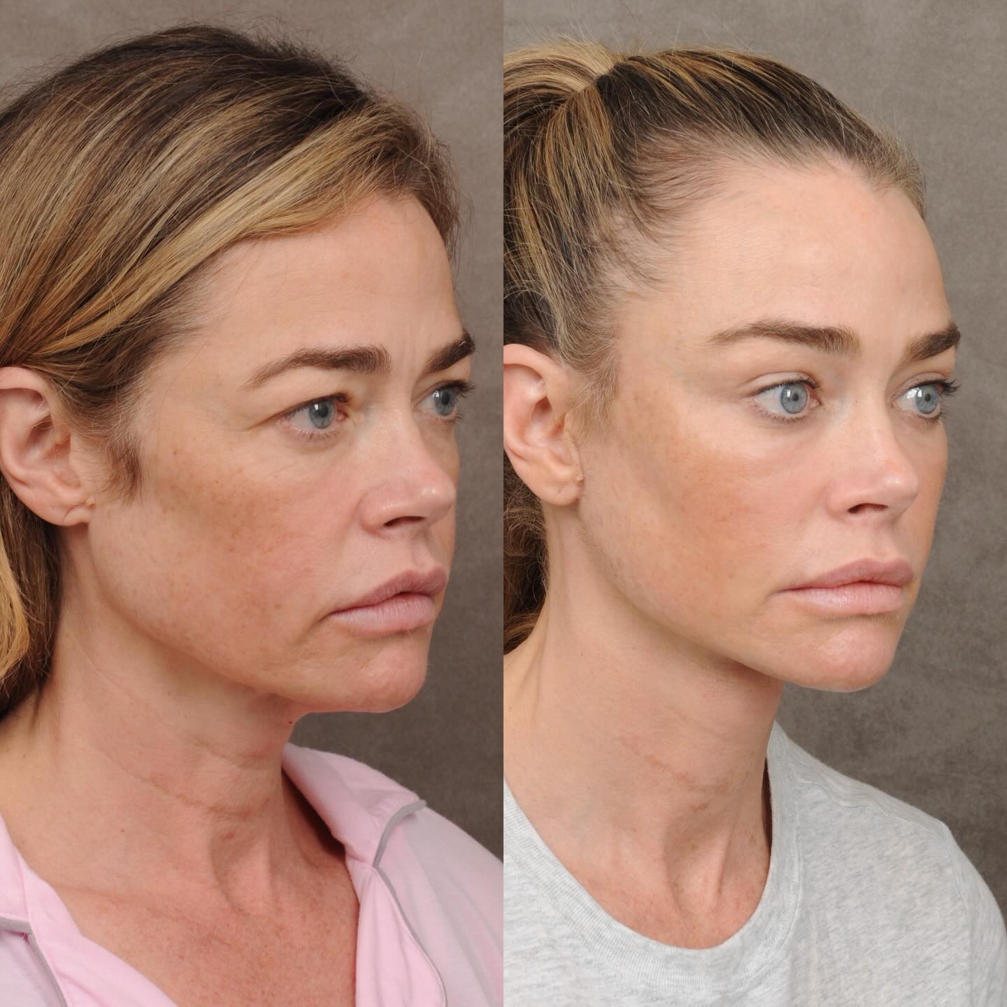Collage of before and after facelift photos of Denise Richards.