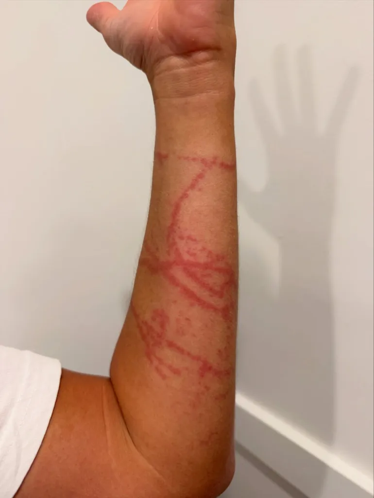 Arm with red welts and marks from a box jellyfish sting.