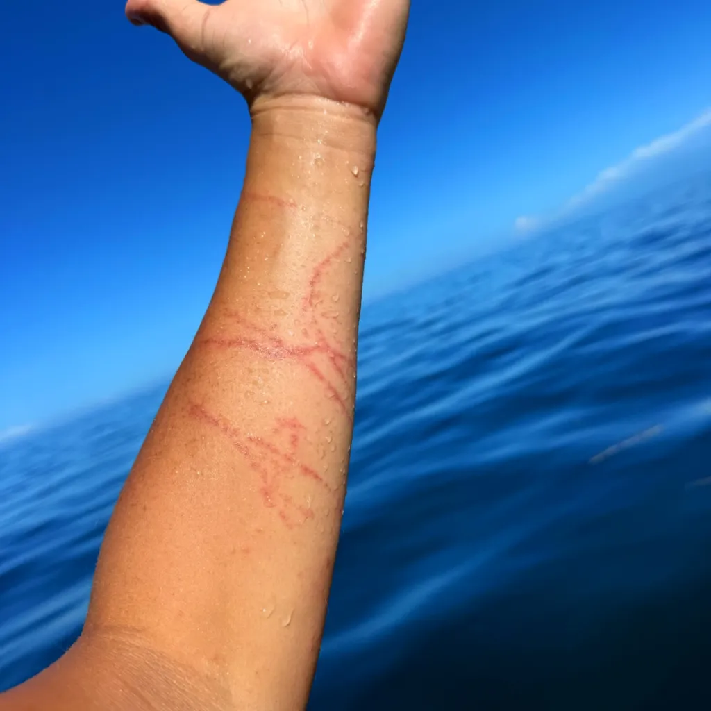 Guy Rowles' arm covered in box jellyfish stings.