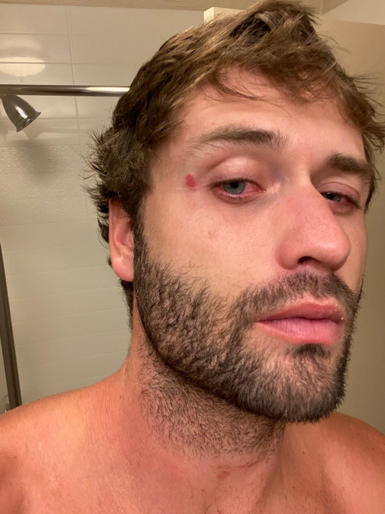 A man with a beard, a red eye, and a red mark on his forehead from alleged domestic violence.