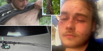 Fisherman survives lightning strike that left him covered in burns: ‘Unluckiest lucky man alive’