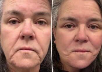 Rosie O’Donnell shares unfiltered before-and-after photos of facelift after undergoing ‘shameful’ procedure