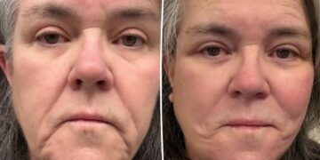 Rosie O’Donnell shares unfiltered before-and-after photos of facelift after undergoing ‘shameful’ procedure