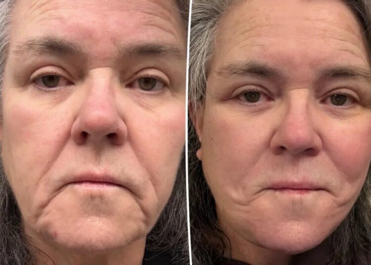 Rosie O’Donnell shares unfiltered before-and-after photos of facelift after undergoing ‘shameful’ procedure