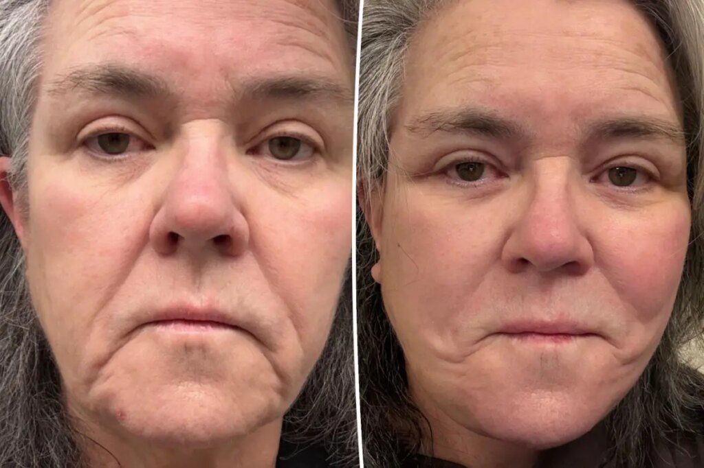 Rosie O’Donnell shares unfiltered before-and-after photos of facelift after undergoing ‘shameful’ procedure