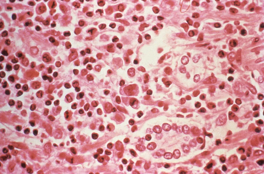 Microscope image of liver tissue affected by Hantavirus Pulmonary Syndrome.