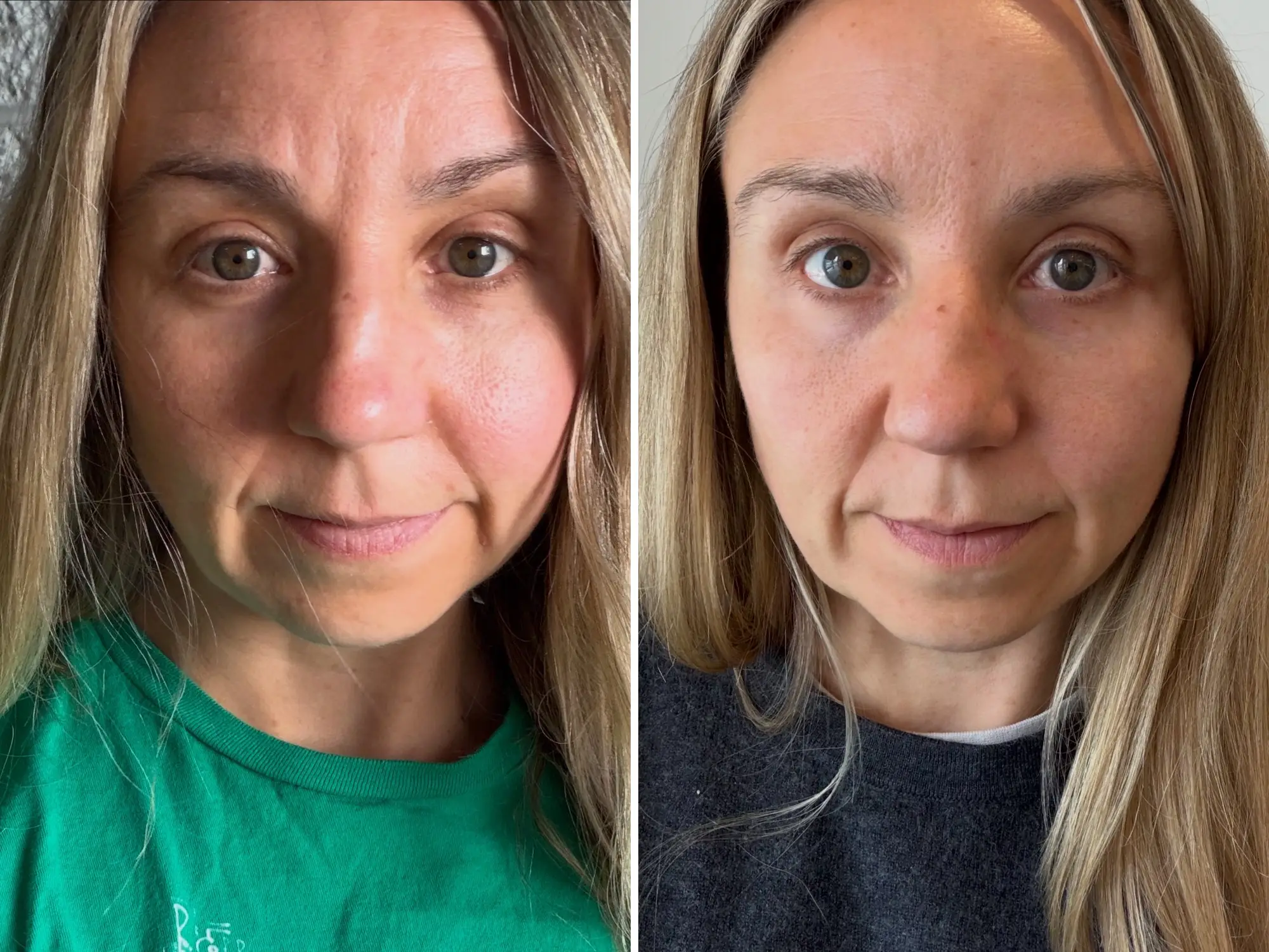 a before and after image of a woman getting Botox