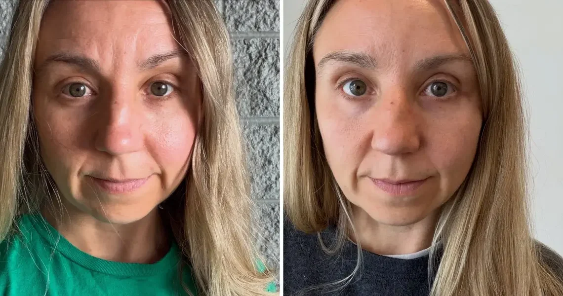 I get Botox as often as I can afford it. My aging face started to distract me on work calls — the cost is worth every penny.