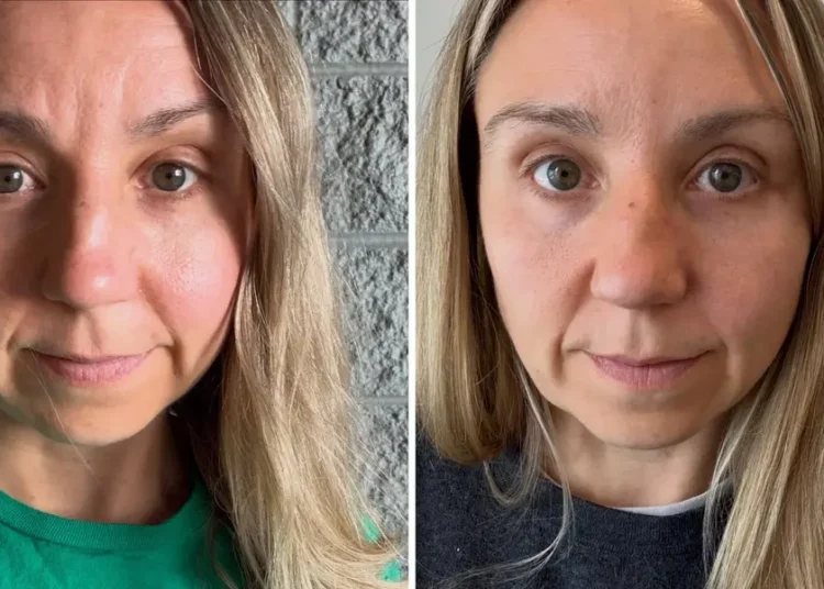 I get Botox as often as I can afford it. My aging face started to distract me on work calls — the cost is worth every penny.
