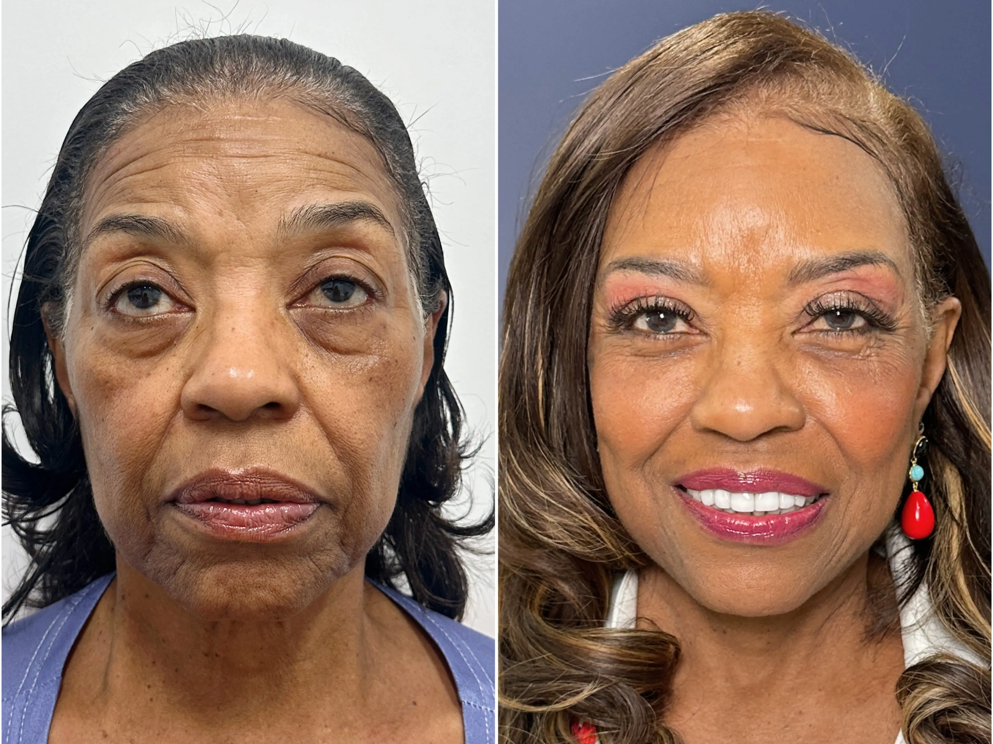 A woman before and after a facelift.