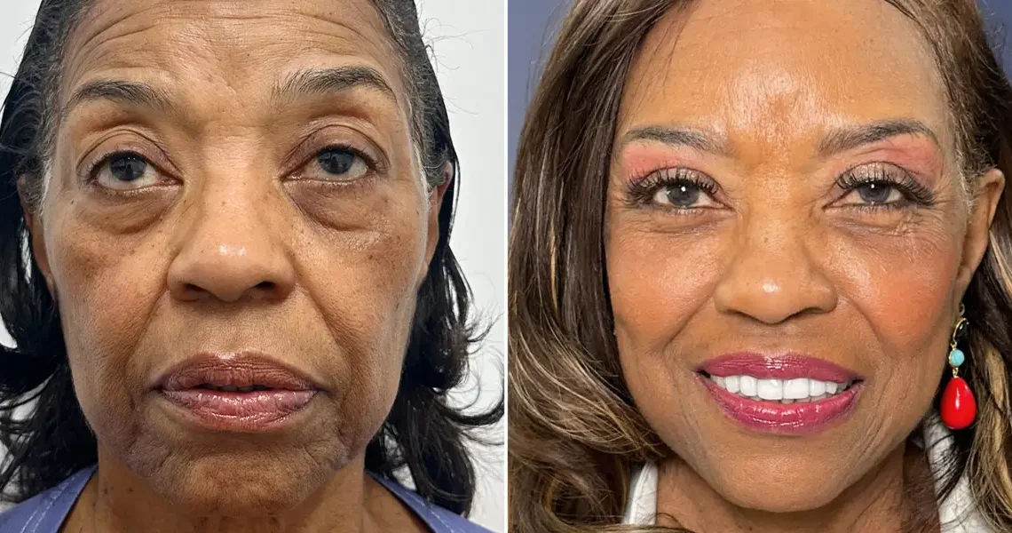 I paid $102,000 for a facelift at 71. I wish I could have done it a decade ago, but I couldn’t afford it.